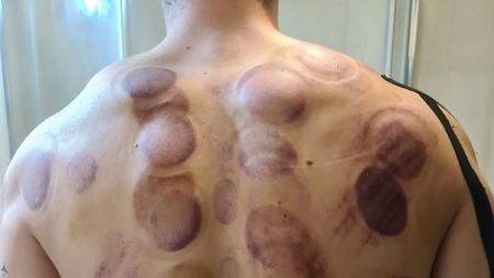 Imagini șocante! Cum arată spatele unui sportiv român calificat la Olimpiada de la Tokyo | GALERIE FOTO