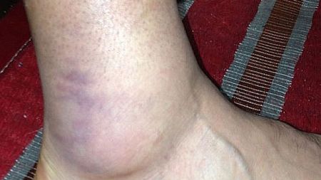 DUREROS! Cât ghinion! FOTO Așa arată piciorul celui mai scump transfer al verii, după ultimul meci