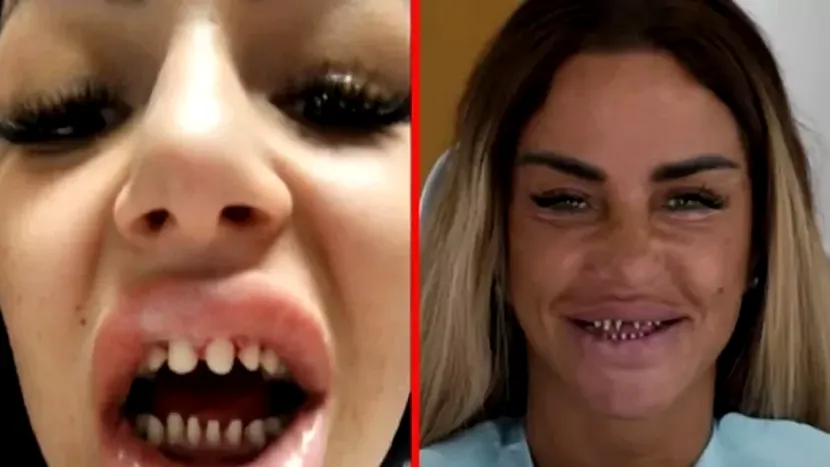 Ce sunt dinții turcești. Stomatologii avertizează cu privire la ultima modă din Marea Britanie