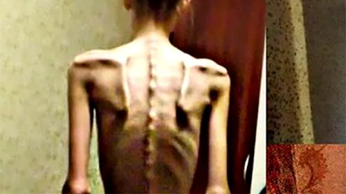 FOTO | Cazul incredibil al unei tinere de 18 ani. În 2014, era anorexică și cântărea DOAR 32 de kilograme! Acum, este antrenoare de fitness și arată uimitor