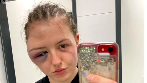 Boxera germană Cheyenne Hanson a suferit o accidentare groaznică la față, după ce s-a ciocnit frontal cu adversara ei în ring!