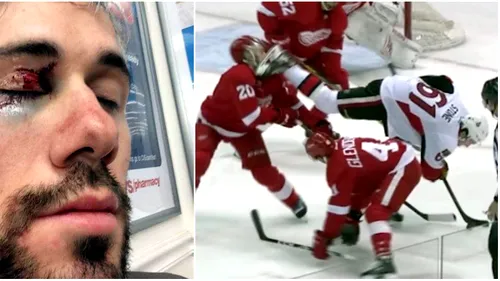 VIDEO | Accidentare horror în NHL. A fost aproape să îi fie tăiat ochiul cu patina. În urmă cu trei ani un puc l-a lovit în gură