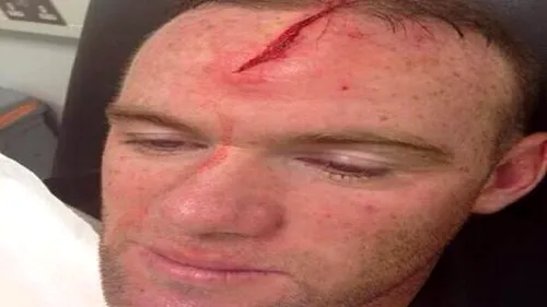 Rooney sau Rambo? FOTO: Vârful e titular la United, după tăietura suferită în cantonamentul naționalei. Cum arată:)