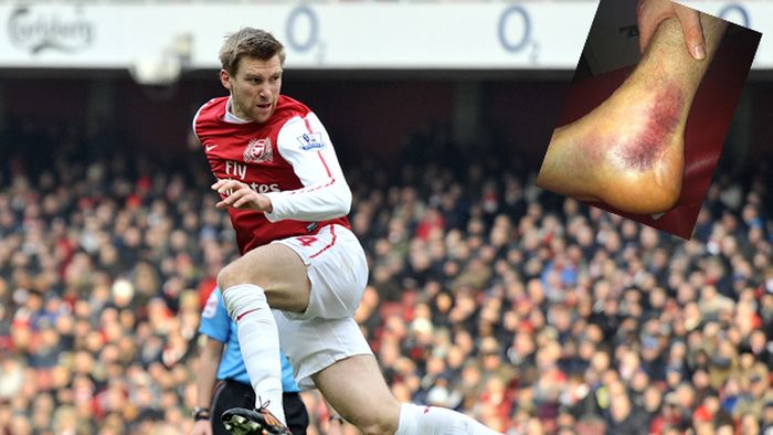 DUREROS! FOTO Când mai revine pe teren?** UITE cum arată piciorul unui star de la Arsenal după ultima accidentare