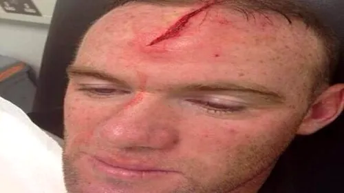 Rooney sau Rambo? FOTO: Vârful e titular la United, după tăietura suferită în cantonamentul naționalei. Cum arată:)