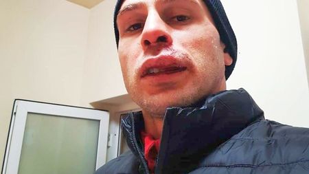 Primele declarații ale lui Slavko Perovic, după accidentarea horror din meciul cu FCSB: „Am doi dinți rupți și buza spartă” | Imagine cu un puternic impact emoțional: „Nu-mi mai aduc aminte”