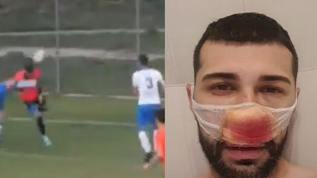Fiul lui Petre Grigoraș, operat de urgență la București! A primit un picior în plină figură în timpul unui meci din Liga 4: „I s-au montat niște tije metalice" | VIDEO