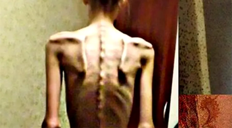 FOTO | Cazul incredibil al unei tinere de 18 ani. În 2014, era anorexică și cântărea DOAR 32 de kilograme! Acum, este antrenoare de fitness și arată uimitor