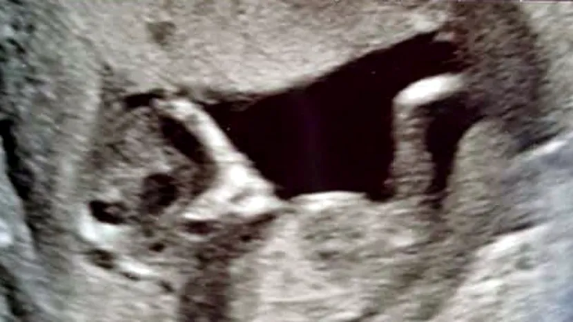 O femeie însărcinată a mers la ecografie și a rămas uluită: „Copilul arăta ca un extraterestru”