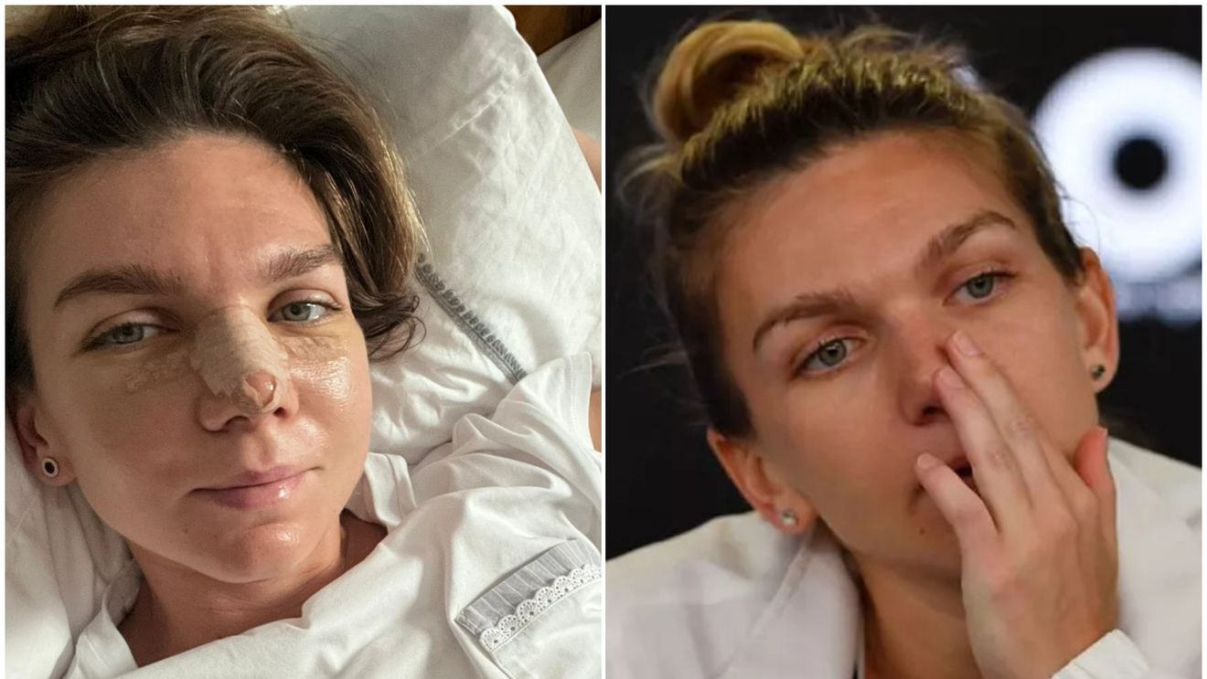Simona Halep a ajuns în cel mai cunoscut tabloid din SUA după ce și-a operat nasul: „Va arăta diferit pe terenul de tenis!" Ce au remarcat americanii la româncă