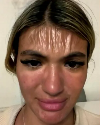 O britanică s-a ales cu o frunte ca de plastic după ce a stat la plajă în Bulgaria timp de 30 de minute