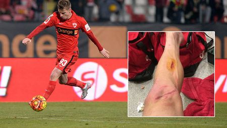 FOTO ȘOCANT | Cum arată piciorul lui Vali Lazăr după intrarea la care Stan a văzut roșu direct. "Nu e nimic rupt..."