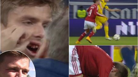 "Victima" lui Sânmărtean încă are dureri. Andersen: "Dinți mei sunt mai bine, dar nu știu încă dacă vor fi salvați". Ce mesaj i-a scris stelistul și ce jucători români l-au impresionat