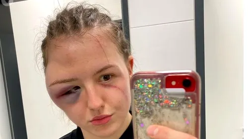 Boxera germană Cheyenne Hanson a suferit o accidentare groaznică la față, după ce s-a ciocnit frontal cu adversara ei în ring!