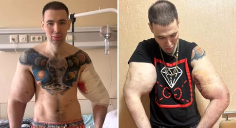 „Popeye”, tânărul care și-a injectat ulei în brațe ca să impresioneze pe internet, a ajuns la spital: „Cum vei câștiga bani acum?”