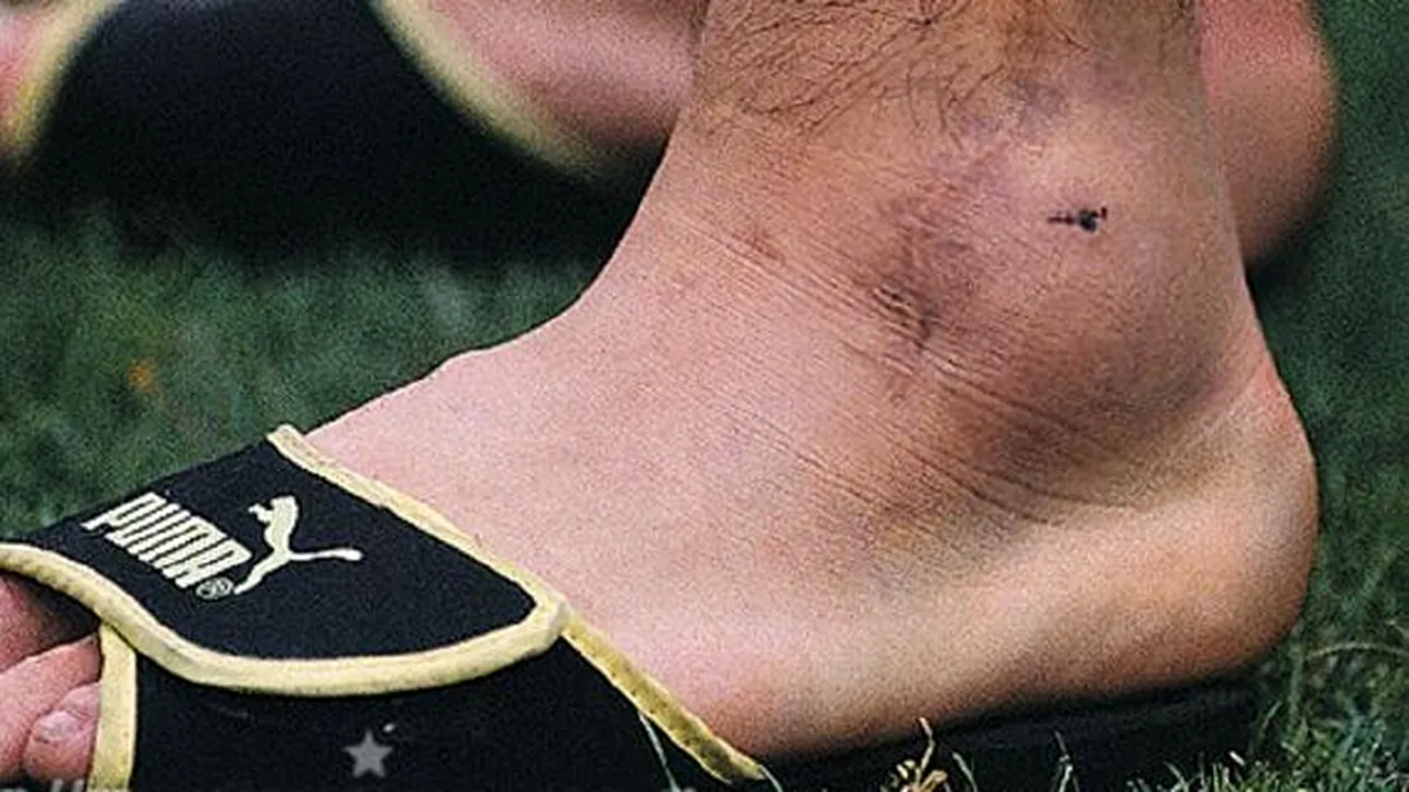 Cum arăta glezna lui Diego Armando Maradona după meciul cu România din 1990 de la Coppa del Mondo. „Avea dimensiunea unei portocale