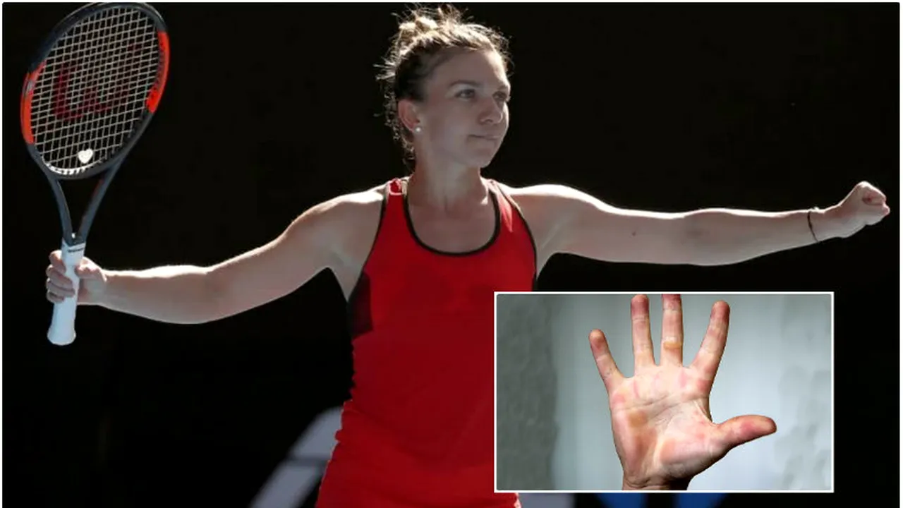IMAGINEA ZILEI | Cum arată mâna Simonei Halep după un meci de tenis