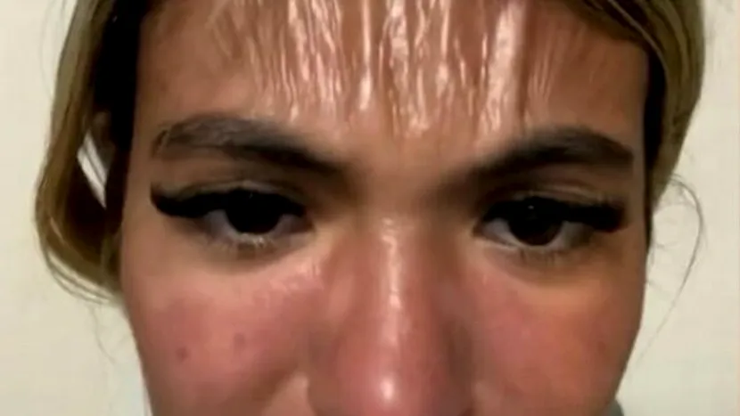 O britanică s-a ales cu o frunte ca de plastic după ce a stat la plajă în Bulgaria timp de 30 de minute