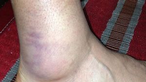 DUREROS! Cât ghinion! FOTO Așa arată piciorul celui mai scump transfer al verii, după ultimul meci