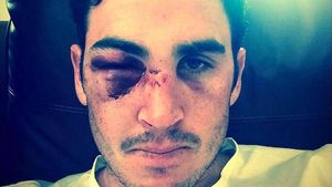 Sportivul care a șocat Twitterul cu selfie-ul postat imediat după ce a primit o minge de cricket în ochi se retrage. Lovitura primită i-a încheiat cariera lui Craig Kieswetter
