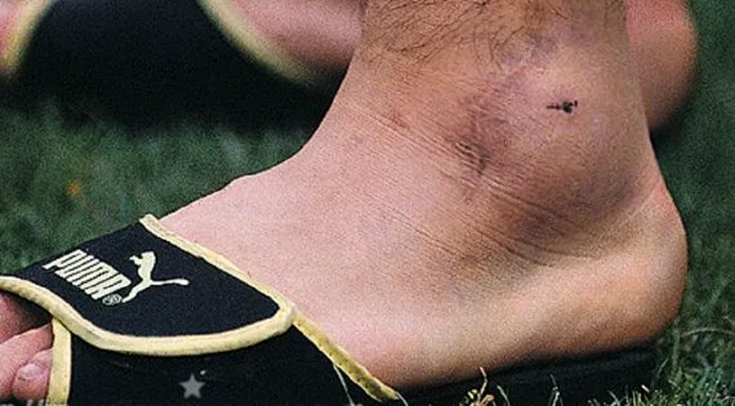 Cum arăta glezna lui Diego Armando Maradona după meciul cu România din 1990 de la Coppa del Mondo. „Avea dimensiunea unei portocale