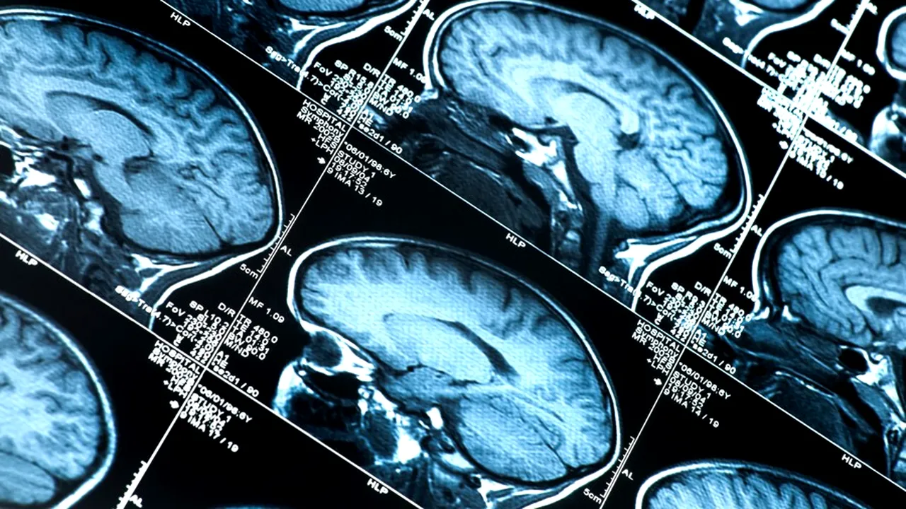 Descoperire șocantă pe creierul unui jucător decedat la 27 de ani. Afecțiunea gravă care riscă să compromită un sport de miliarde de dolari 