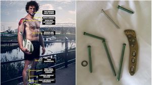 FOTO ȘOCANT | Nu e magazin de feronerie, e metalul scos de doctori din corpul celui mai accidentat rugbist din lume. "Îmi fac griji pentru viitor, am doi copii de crescut" 