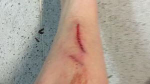 Ovidiu Popescu reloaded. Probleme înaintea meciului cu Polonia. FOTO | Piciorul unui "tricolor" arată groaznic după ultima accidentare suferită