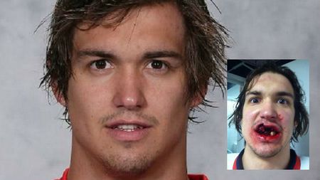 FOTO HORROR: "Selfie"-ul care a șocat internetul. Colegiii nu l-au putut privi. Cum arată după cea mai dură accidentare a anului