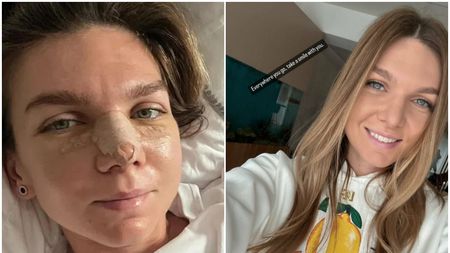 Doctorul care i-a făcut operația estetică Simonei Halep explică pe înțelesul tuturor procedeul: „Nasul operat trebuie să-și păstreze unicitatea!" FOTO