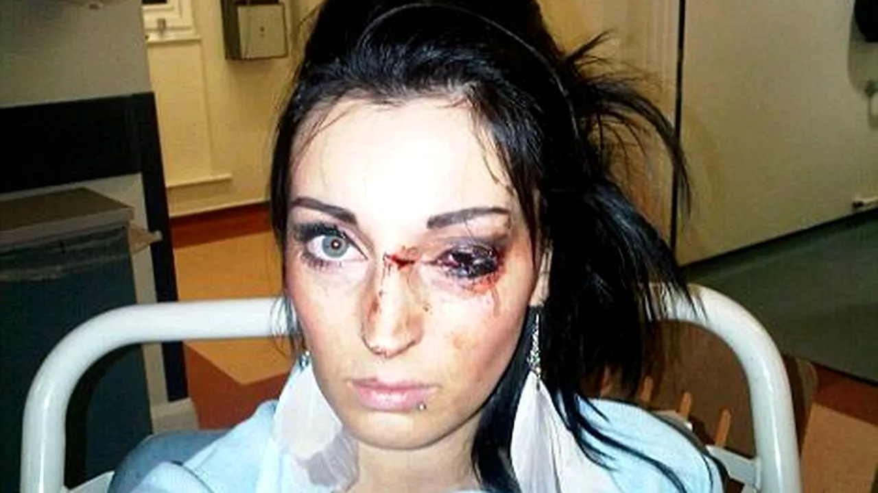 Un rugbyst a desfigurat o tânără după ce a lovit-o cu o sticlă în față!