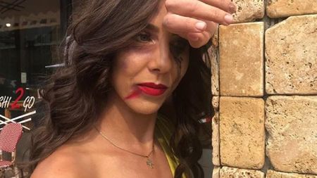 VIDEO | Mihaela Buzărnescu, mai sexy ca niciodată, dar plină de "vânătăi". Sportiva a pus punctul pe i: "Și o palmă e importantă"