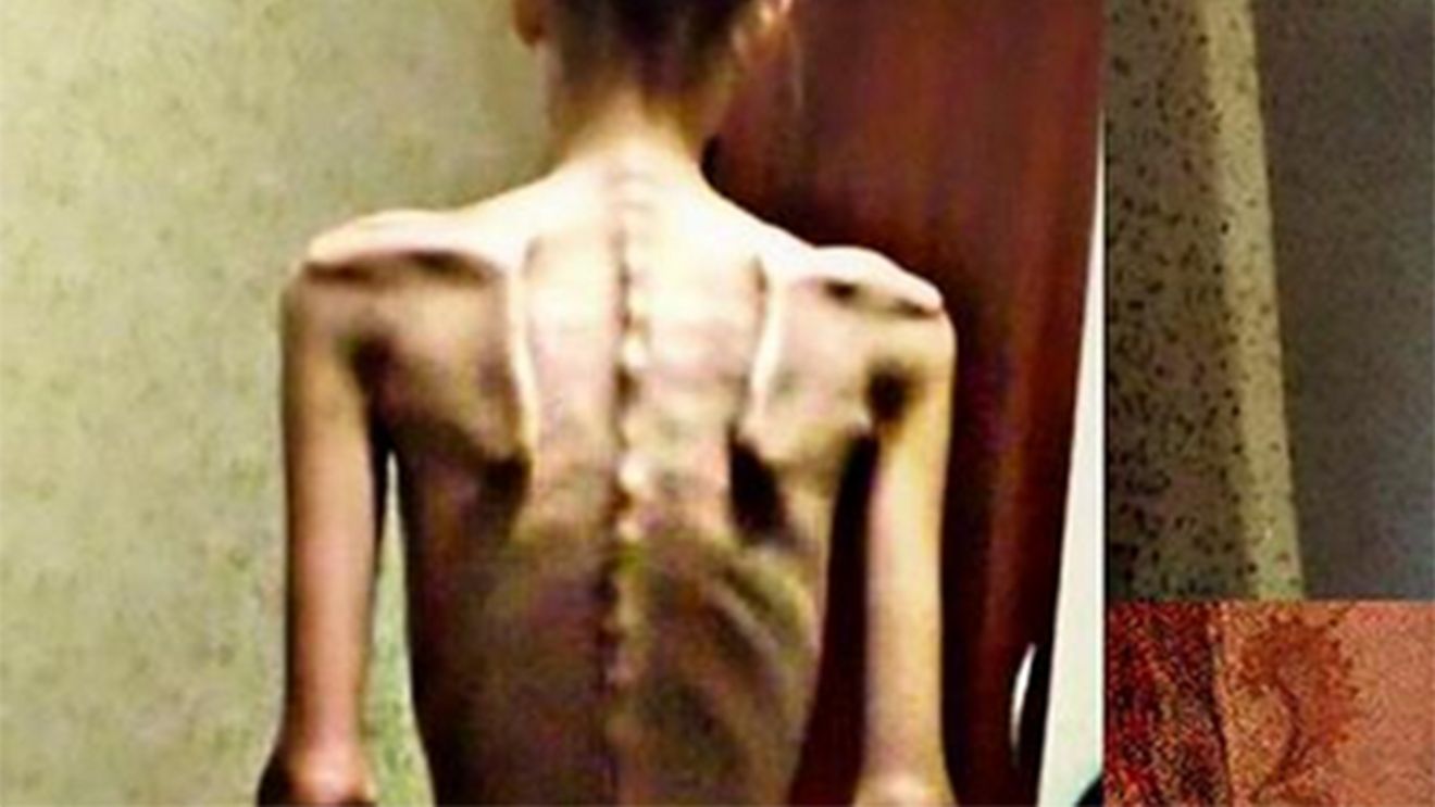 FOTO | Cazul incredibil al unei tinere de 18 ani. În 2014, era anorexică și cântărea DOAR 32 de kilograme! Acum, este antrenoare de fitness și arată uimitor
