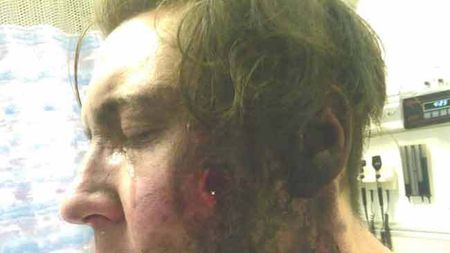 Fost fotbalist, mutilat de explozia unei țigări electronice. La ce riscuri sunt supuși cei 3,7 milioane de români care folosesc E-Cigarette | VIDEO ȘOCANT