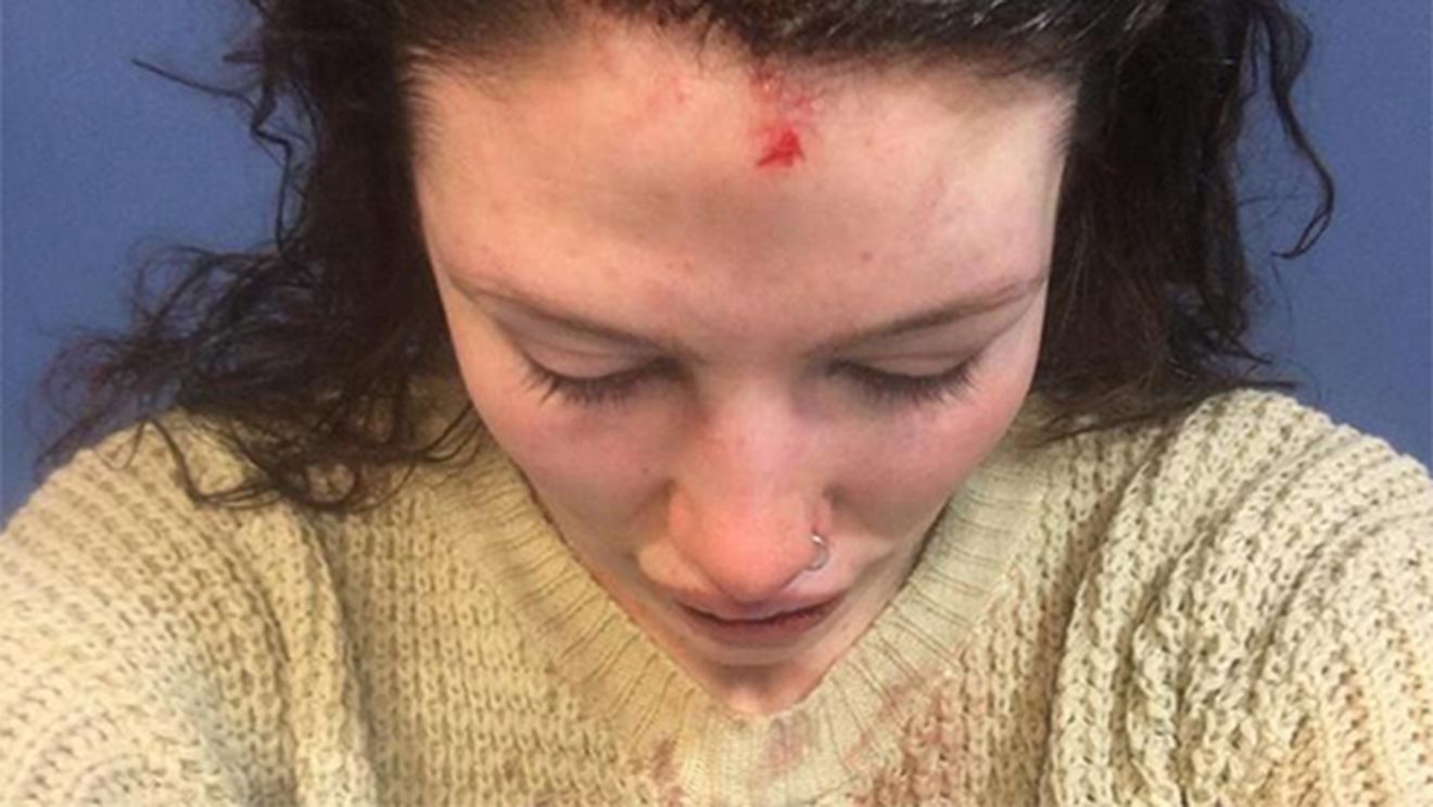 FOTO INCREDIBIL | Un jucător de cricket și-a desfigurat iubita cu bătaia