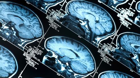 Descoperire șocantă pe creierul unui jucător decedat la 27 de ani. Afecțiunea gravă care riscă să compromită un sport de miliarde de dolari 