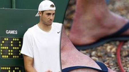 FOTO **Așa arăta piciorul lui Isner la capătul celui mai lung meci din istorie