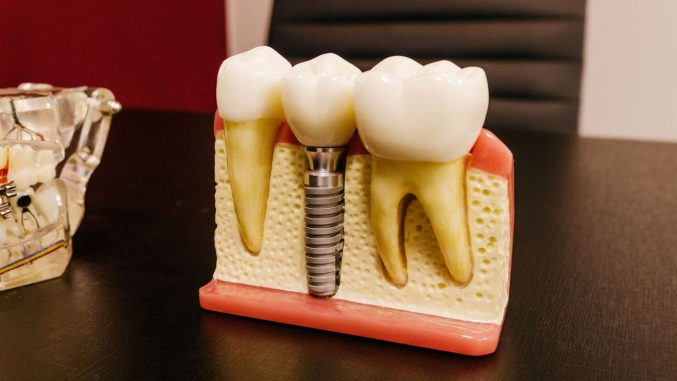 (P) Cât rezistă un implant dentar și de ce depinde