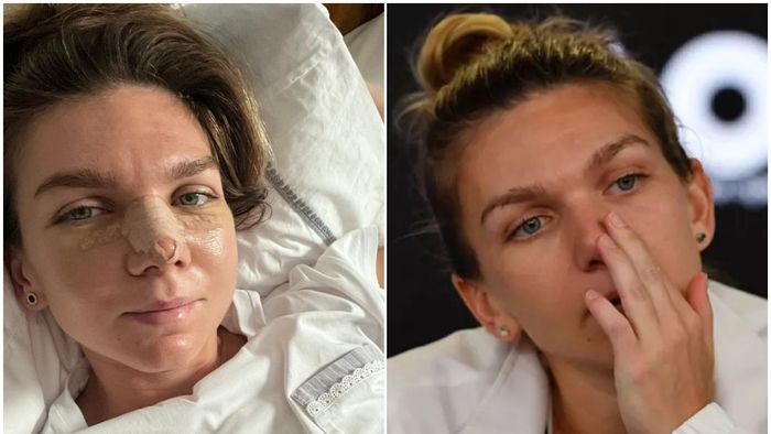 Simona Halep a ajuns în cel mai cunoscut tabloid din SUA după ce și-a operat nasul: „Va arăta diferit pe terenul de tenis!" Ce au remarcat americanii la româncă