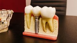 (P) Cât rezistă un implant dentar și de ce depinde