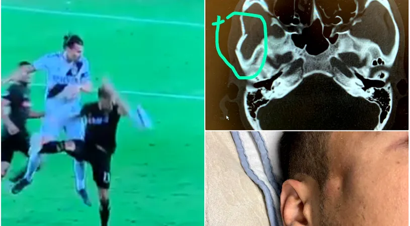 FOTO & VIDEO Horror! Un fotbalist s-a ales cu o gaură în cap după un duel aerian cu Zlatan Ibrahimovic