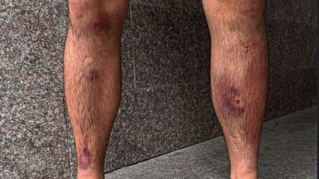 Cutremurător! Așa arată picioarele unui campion mondial după cinci runde: Sebastian Lutaniuc, victorie dură în fața brazilianului Guilherme de Assis. SPECIAL