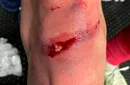 Imagini șocante: așa arată genunchiul lui Dumitrescu de la Sepsi după intrarea lui Paramatti. Chivulete a dat doar galben, iar VAR-ul nu a intervenit! | EXCLUSIV