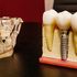 (P) Cât rezistă un implant dentar și de ce depinde