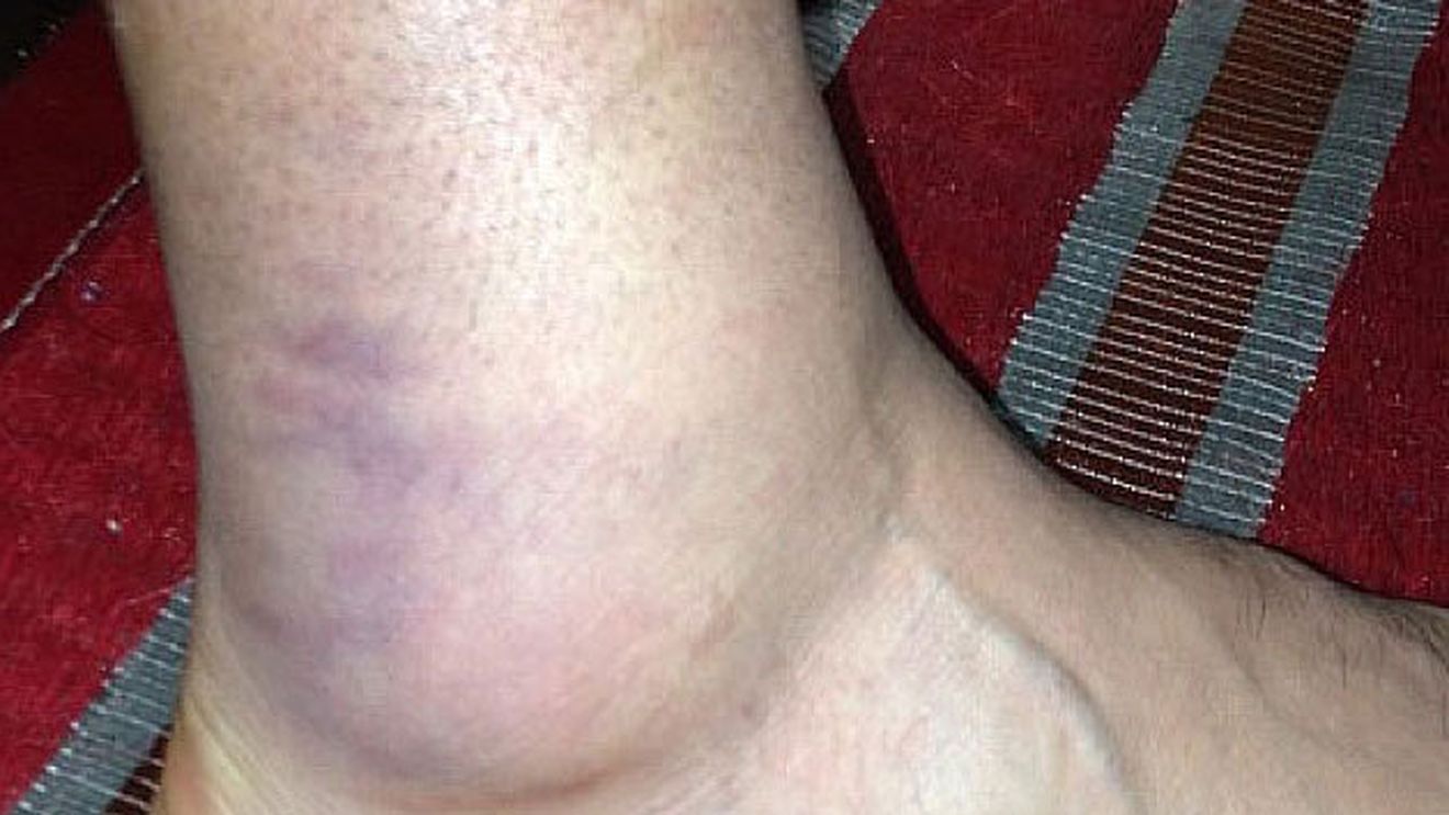 DUREROS! Cât ghinion! FOTO Așa arată piciorul celui mai scump transfer al verii, după ultimul meci