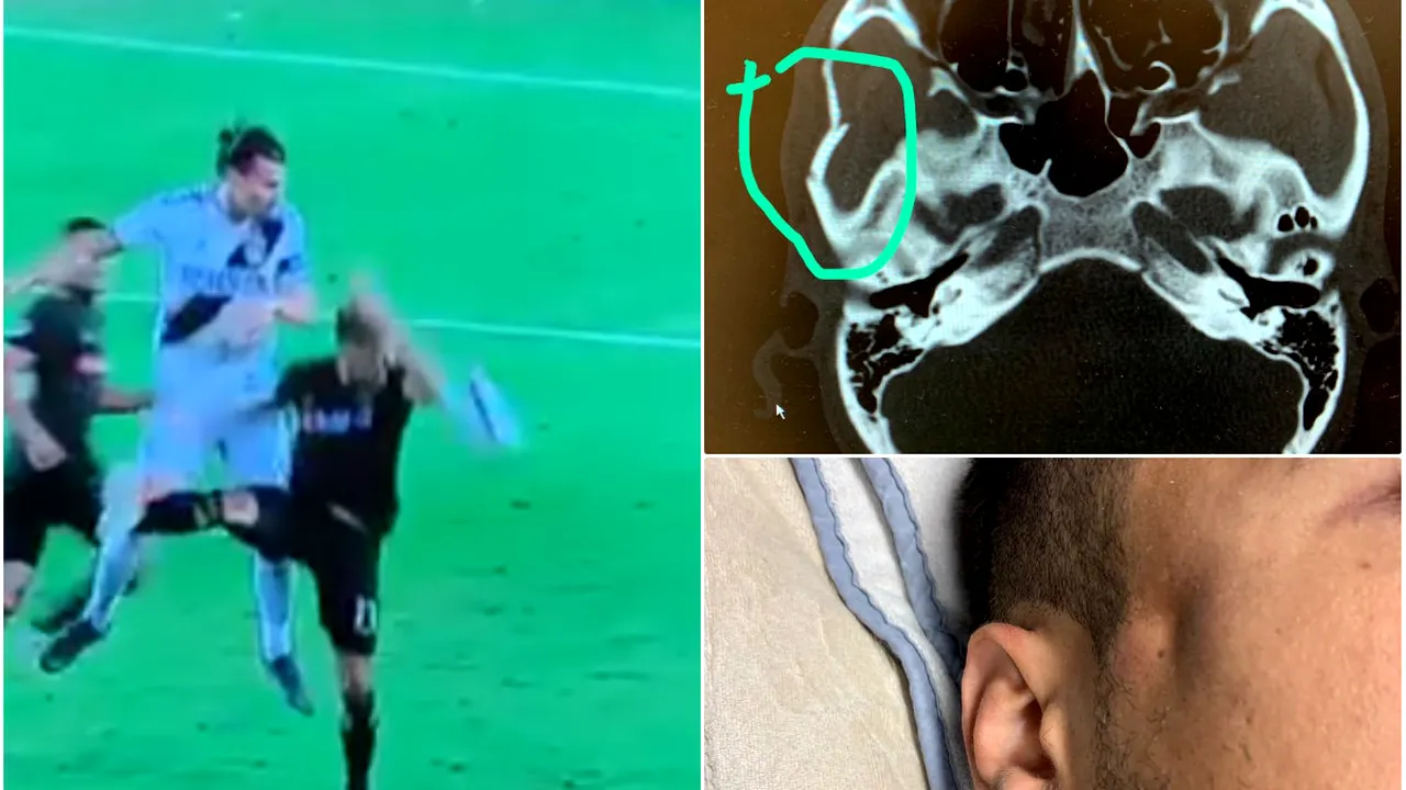 FOTO & VIDEO Horror! Un fotbalist s-a ales cu o gaură în cap după un duel aerian cu Zlatan Ibrahimovic